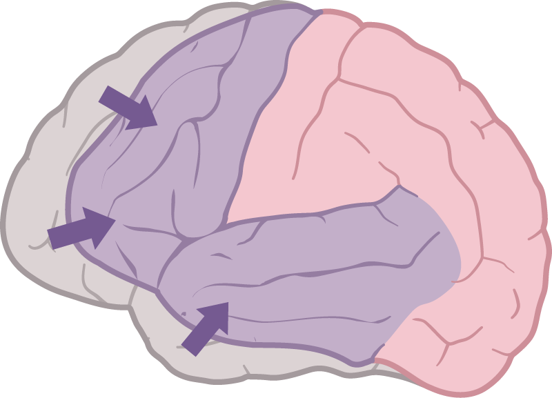 前頭側頭型認知症